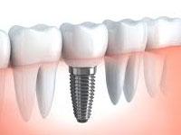 Dr Chetan Bholes Dental Clinic offers