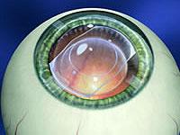 Global Lasik and Laser Centre offers