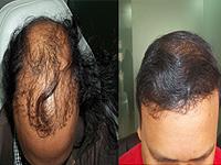 Hairline International Hair Clinic offers