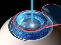 Dr Gadgil Eye Clinic Lasik Centre offers