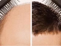The Sparsh Klinic Skin Care and Hair Transplant offers