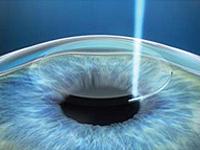 Ramesh Lasik and Laser Centre offers