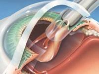 Dr Pattnaiks Laser Eye Institute offers