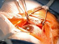 Mumbai Eye Care Cornea and Lasik Centre coupons
