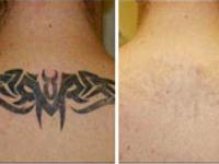 Delhi Laser Clinic coupons