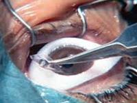 Ramesh Lasik and Laser Centre coupons