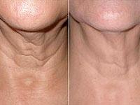 Kyra Laser & Skin Clinic coupons